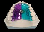 Removable Expander for Effective Orthodontic Treatment and Smile Enhancement