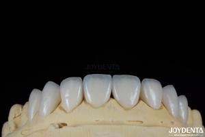China Glossy Surface Texture Feldspathic Veneer Natural Looking Porcelain Veneer factory