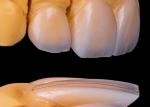 Translucency Porcelain Emax Veneer for Excellent Fit / Natural Esthetics
