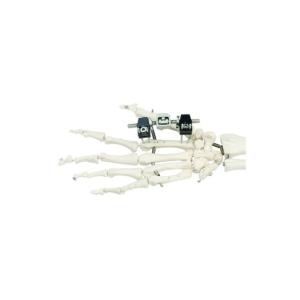 China Factory Price Mini Fragment Orthopedic Orthofix External Fixator With Pins For Finger factory