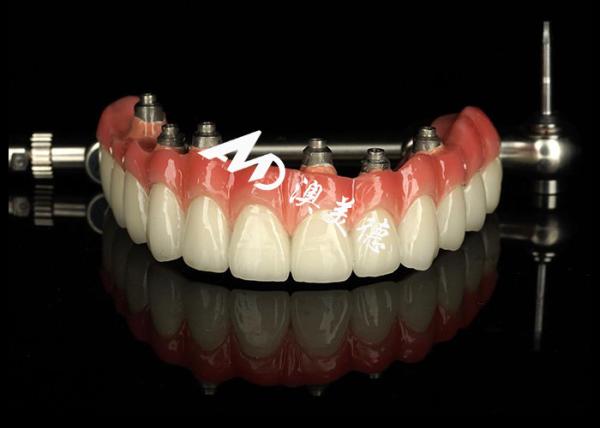 Customized Dental Implant supported dentures Crown Bridge For Missing Teeth