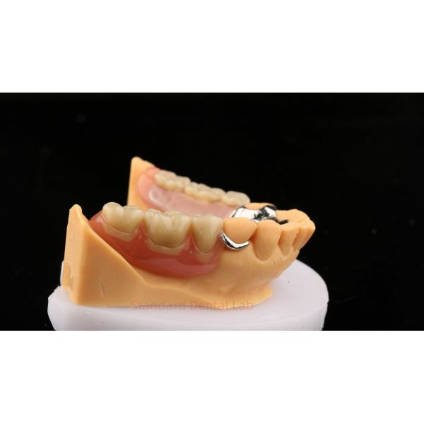 Metal Alloys Cobalt Chromium Partial Denture Ivoclar Scheftner Comfortable Cast Metal Framewrok