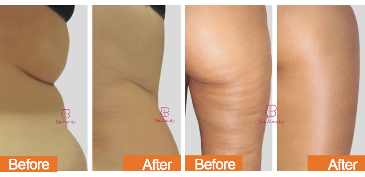 Cellulite Reduction Skin Toning Body Contouring Therapy Machine