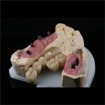 Cad Cam Implant PFM Crown Bridge Dental Medical Grade Adhesive