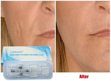 Hyaluronic Acid Injectable Filler 10ml For Lip Injection Cheeks Chin Augmentatio