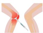 3ml Knee Pain Mesotherapy Solution Non Crosslinked Hyaluronic Acid