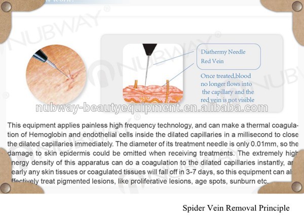 30.56MHz RBS Blood Vessel Portable Spider Vein Removal Machine For Sale