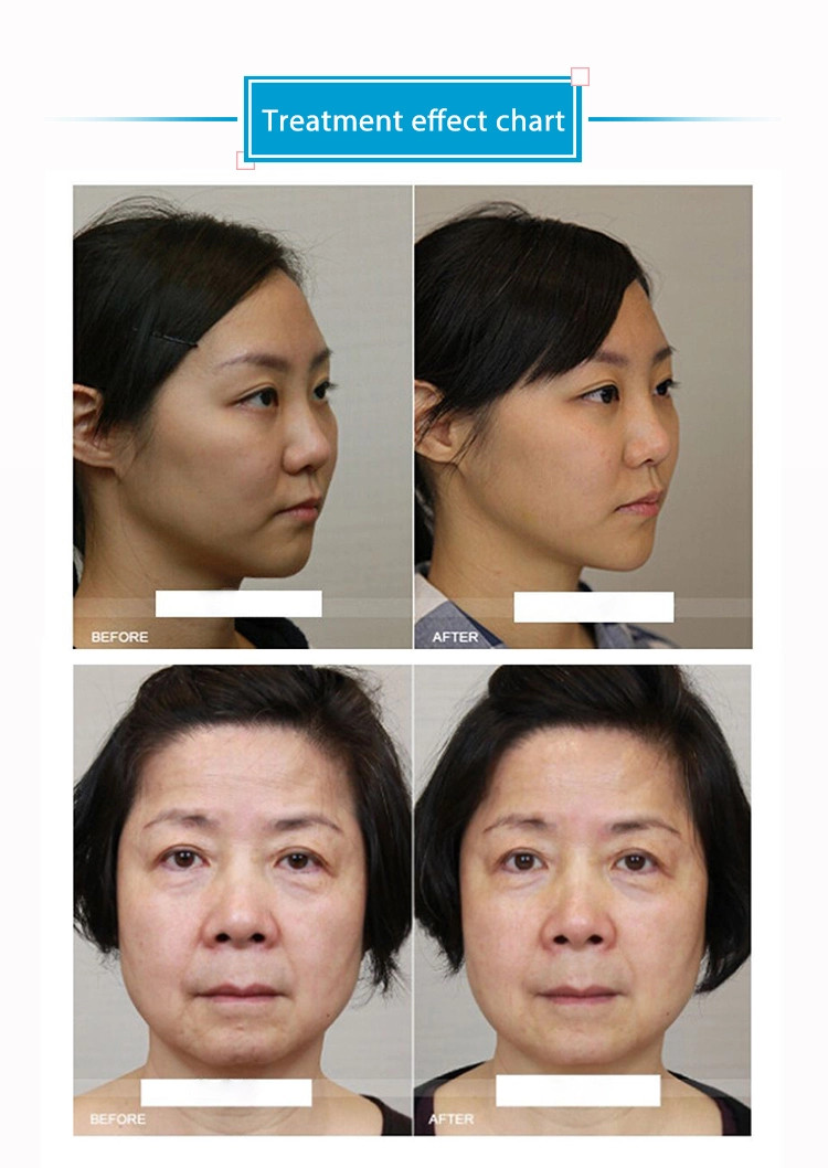 2 in 1 Vmax hifu +2D Hifu skin Tightening Hifu face lift Machine LF-416