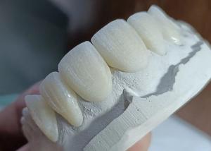 China Strength Wear Resistant Ceramic crown Bridge for Comfortable Precise Dental Restoration factory