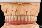 1 Piece Ti-Base Acrylic Teeth Finish Translucent Color Dental Acrylic Resins
