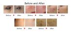 Continuous Fotona Fractional Co2 Laser Beauty Machine For Dark Circles