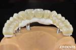 High Strength Ti-Base Hybrid Zirconia Bridge Fracture Resistance Dental Solution