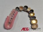 ADS Precision Attachment Dental Telescopic Crowns Mechanism