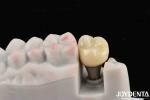 Biocompatible Dental Implant Crown And Bridge Aesthetically Pleasing For Safe