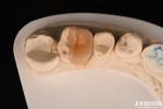 Zirconia Inlay Onlay With Adhesive Cementation For Damaged Teeth Restoration