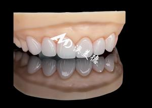 China Porcelain EMAX Veneer High Precision Esthetic Restorations with Superior Durability factory