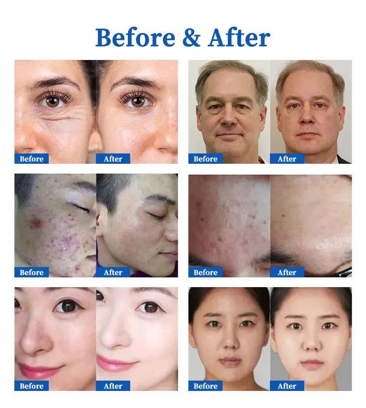 Anti Acne Spot Freckle Removal Skin Lifting Plasma Pen Double Chin Removal Machine