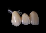 High Strength Zirconia Dental Crown For Single Or Multiple Teeth Replacement