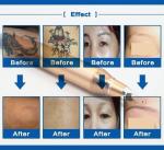 OEM Q Switch Commercial Tattoo Removal Machine White Color ND Yag Laser