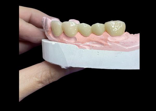 All Ceramic Crowns and Bridges Designed for Superior Aesthetics Durability and