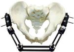 Pelvic Fracture Orthopedic External Fixator Implant Materials For Trauma