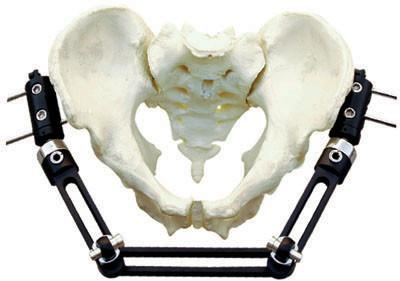 Pelvic Fracture Orthopedic External Fixator Implant Materials For Trauma