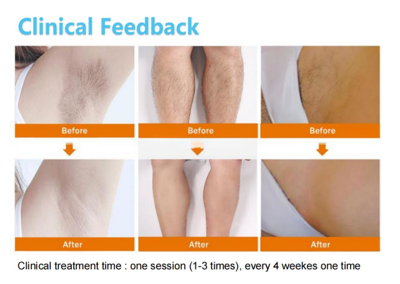 808nm Wavelength Diode Laser Hair Removal Machine - with 15.6 Inch Color Touch Screen