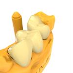 Low Temperature Expansion Coefficient Permanent Crown Resin Close to Natural