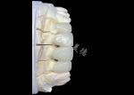 Natural-Looking Zirconia Ceramic Crown Bridge Provides Precision And Aesthetics