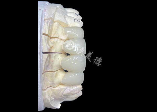 Natural-Looking Zirconia Ceramic Crown Bridge Provides Precision And Aesthetics