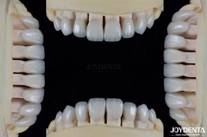 China Ceramic For Natural Aesthetics Dental Veneers Stain Resistance Maintains Brightness Strong Bond With Tooth Enamel For Secure Fit factory