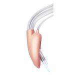 Size 3 Disposable Anesthetic Laryngeal Mask , PVC LMA Supraglottic Airway