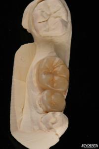 China Emax Dental Inlays And Onlays Fracture Resistant 1.5mm Low Translucency factory