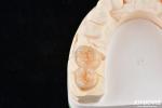 Natural Looking Dental Zirconia Inlays And Onlays High Esthetically Precise Fit