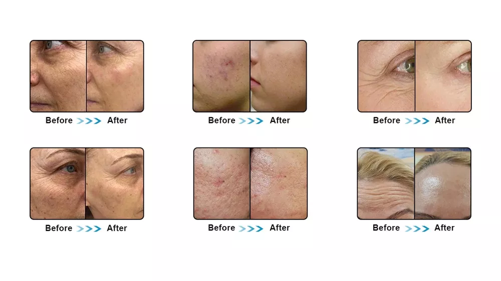 Skin Care Face Lifting RF Microneedling Fractional RF Microneedle Machine