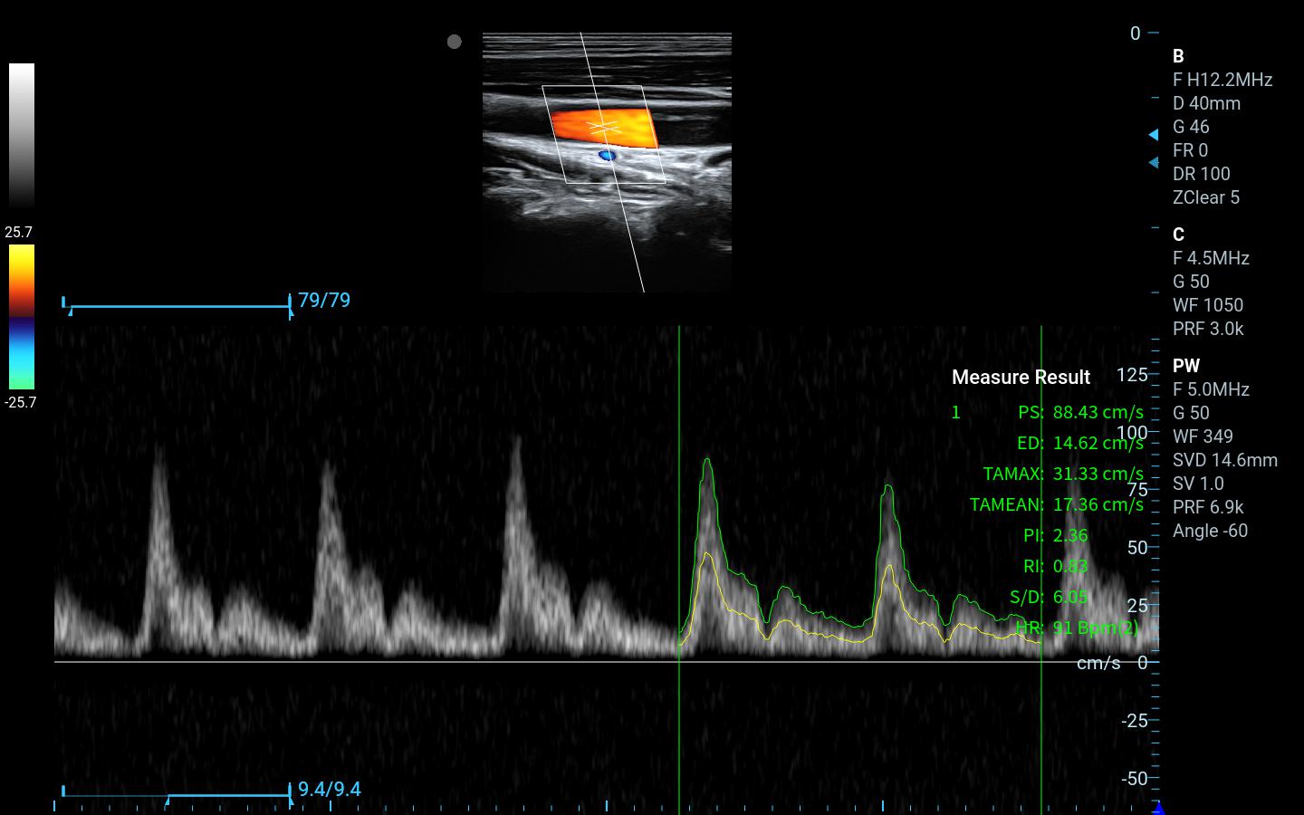 Best Price CW, TDI , PDI Handheld Portable Ultrasonido 3D 4D Veterinary Doppler Ultrasound Machine