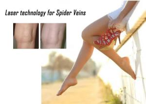 China 1064nm Spider Vein Removal Machine 532nm KTP Non Invasive Laser Treatment factory