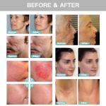 Face Lifting RF Microneedling Machine Wrinkle Acne Scar Removal Machine