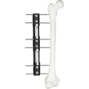 China Pediatric LRS system orthofix Limb Lengthening External Fixator factory