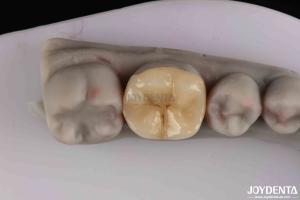 China Customizable Zirconia Inlay Onlay Minimal Preparation For Damaged Teeth Restoration factory
