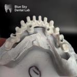 Pure Titanium Frame Malo Bridge Customizable Blue Sky Implant