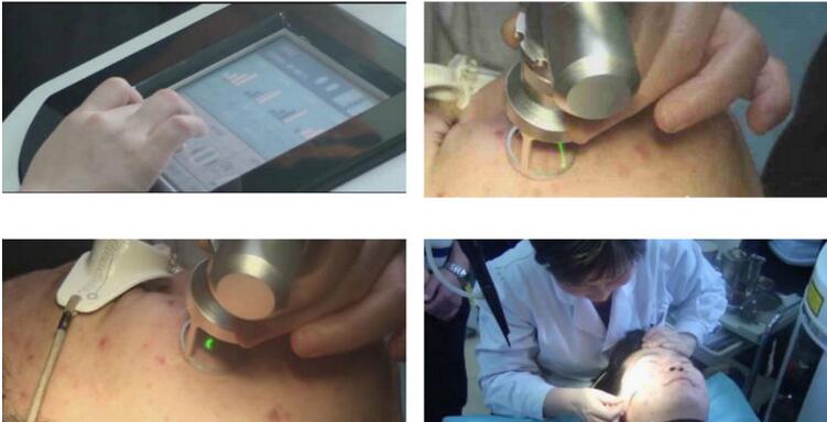 40W RF Tube Laser Generator Vaginal Tightening Laser CO2 Fractional machine