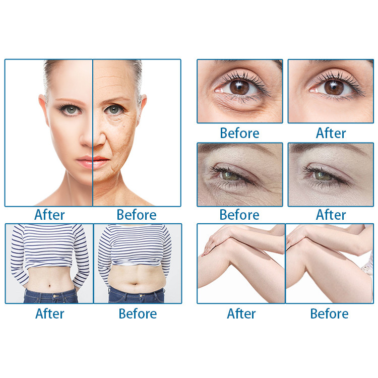 Slimming Body Ultrasound HIFU Machine , SMAS Face Lifting HIFU 7D Machine