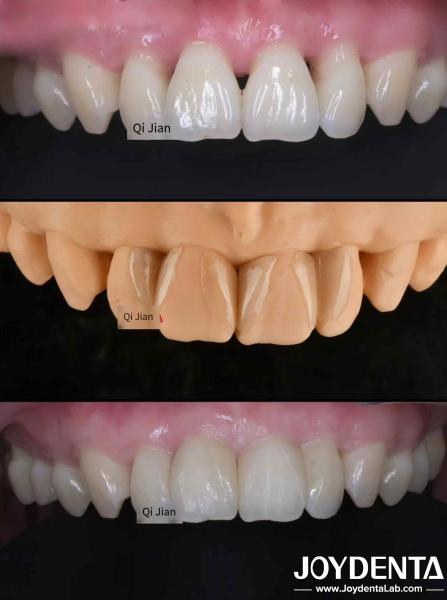 Grassshopper Veneers The Perfect Solution For Natural Translucency Dental