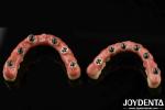Hybrid Technology Titanium Malong Dental Bridge Adjustable For Aesthetic Results