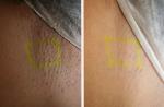 Portable Professional Ipl Laser Hair Removal Machines For Skin Rejuvenation