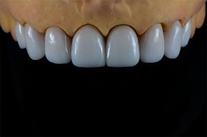 China Natural Porcelain E-Max Crown Full Veneer In Demistry Restorations factory