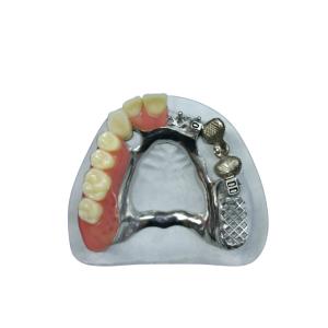 China Beautiful Appearance Precision Attachment Denture Implant Attachments factory