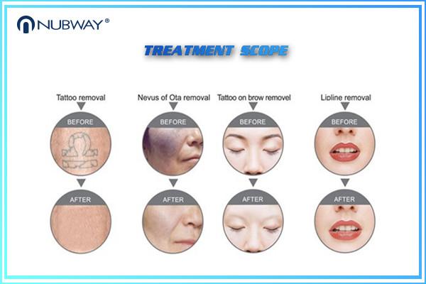 Nubway Q Switched Nd Yag Laser Tattoo Removal Pigmentation Removal Machine