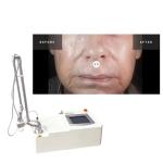 Portable 15w Co2 Fractional Acne Surgical Scar Laser Machine